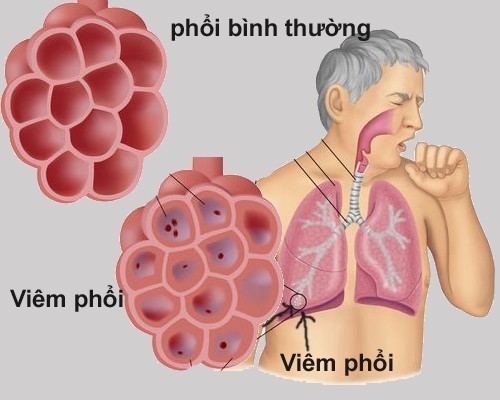 Bệnh viêm phổi tình trạng phổi bị viêm, ảnh hưởng