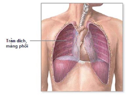 Bệnh viêm phổi và biến chứng thường gặp