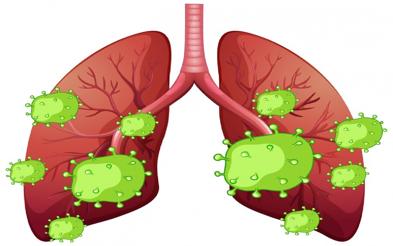Bệnh viêm phổi và thông tin tổng quan