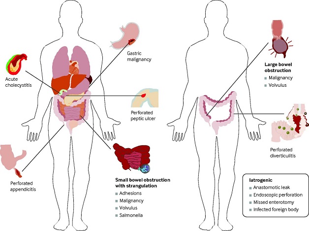 Bệnh viêm phúc mạc – Tất tần tật các vấn đề cần lưu ý