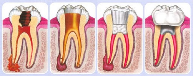 Bệnh viêm quanh cuống răng tuyệt đối đừng coi thường