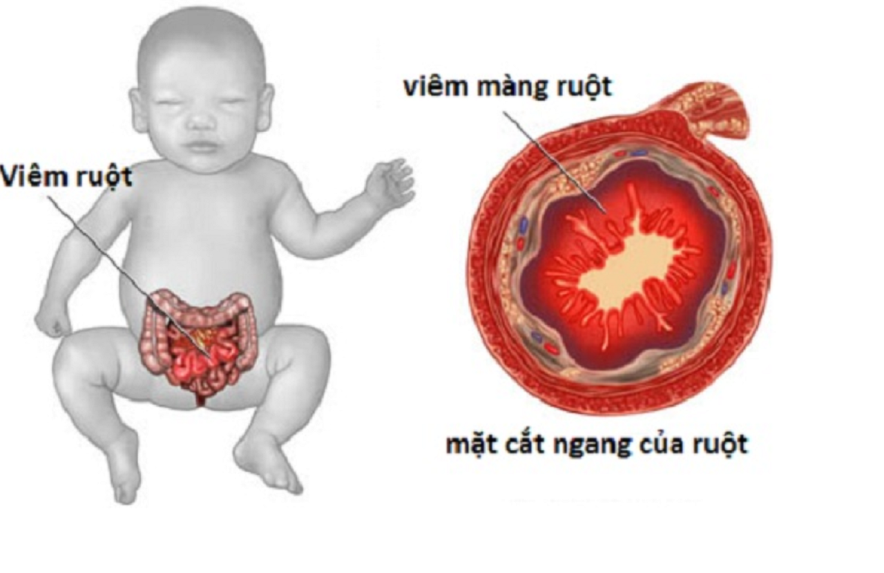 Bệnh viêm ruột hoại tử ở trẻ: Nguyên nhân, dấu hiệu và điều trị