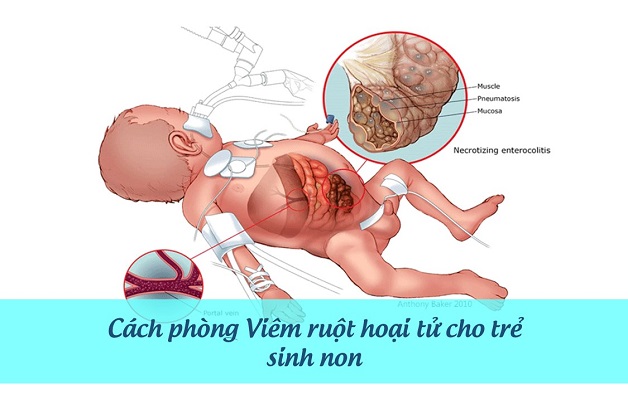 Bệnh viêm ruột hoại tử ở trẻ: Nguyên nhân, dấu hiệu và điều trị