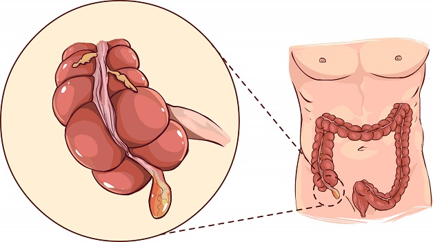 Bệnh viêm ruột thừa: Cách chẩn đoán và điều trị