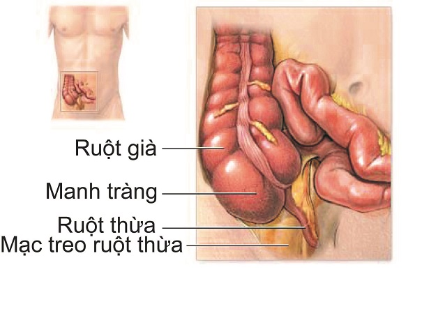 Bệnh viêm ruột thừa: nguyên nhân, triệu chứng và cách điều trị