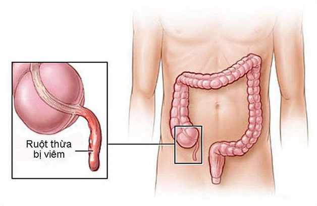 Bệnh viêm ruột thừa và các kiến thức cần biết