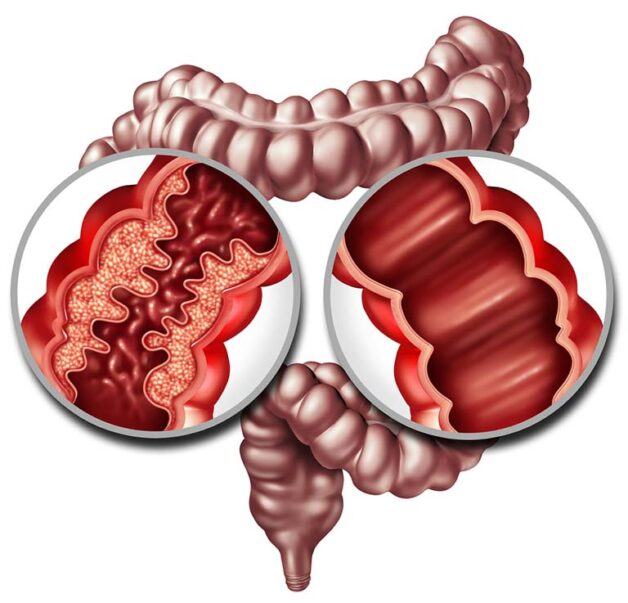 Bệnh viêm ruột tự miễn: Nguyên nhân, cách chăm sóc