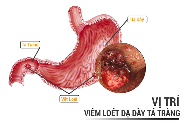 Bệnh viêm tá tràng: nguyên nhân, triệu chứng và cách điều trị