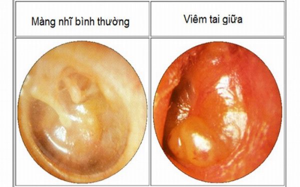 benh viem tai giua cap o nguoi lon la gi 1