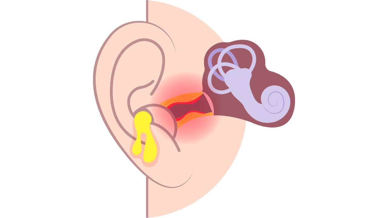 Bệnh viêm tai giữa ở trẻ và những điều bố mẹ cần biết