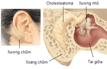 Bệnh viêm tai xương chũm ở trẻ em có nguy hiểm không?