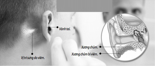 Bệnh viêm tai xương chũm ở trẻ em có nguy hiểm không?