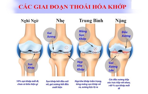 Bệnh viêm thoái hóa khớp gối nguy hiểm như thế nào?