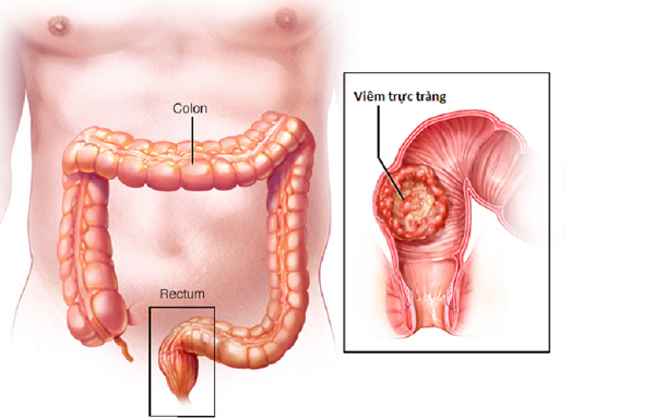 Bệnh viêm trực tràng là gì?