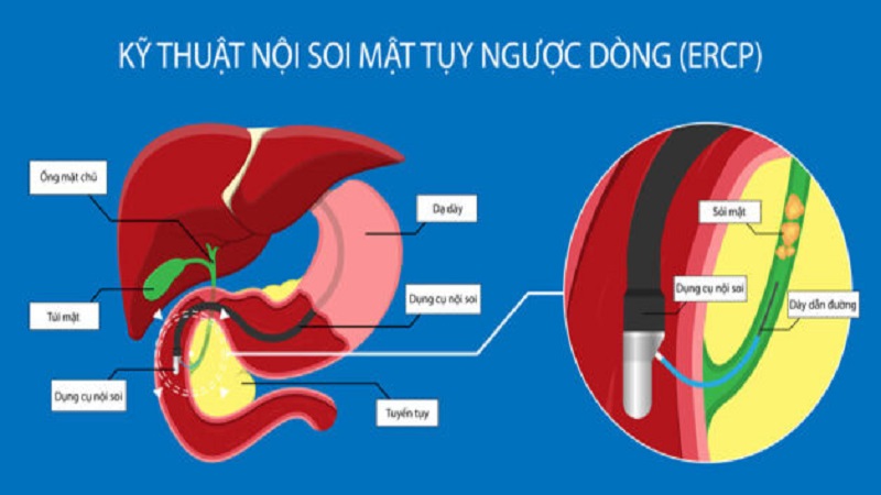 Bệnh viêm tụy cấp và những điều cần biết