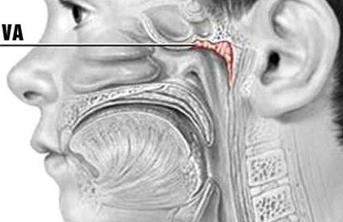 Bệnh viêm VA là gì?Cách nhận biết và điều trị như thế nào