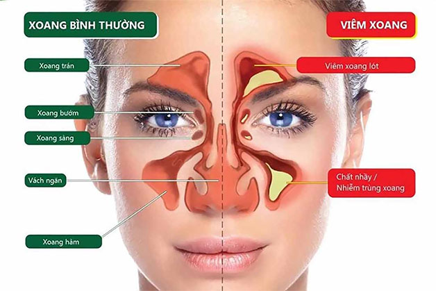 Bệnh viêm xoang mũi có nguy hiểm không và nguyên tắc điều trị