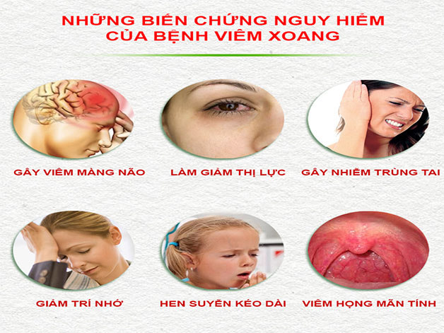 Bệnh viêm xoang mũi có nguy hiểm không và nguyên tắc điều trị