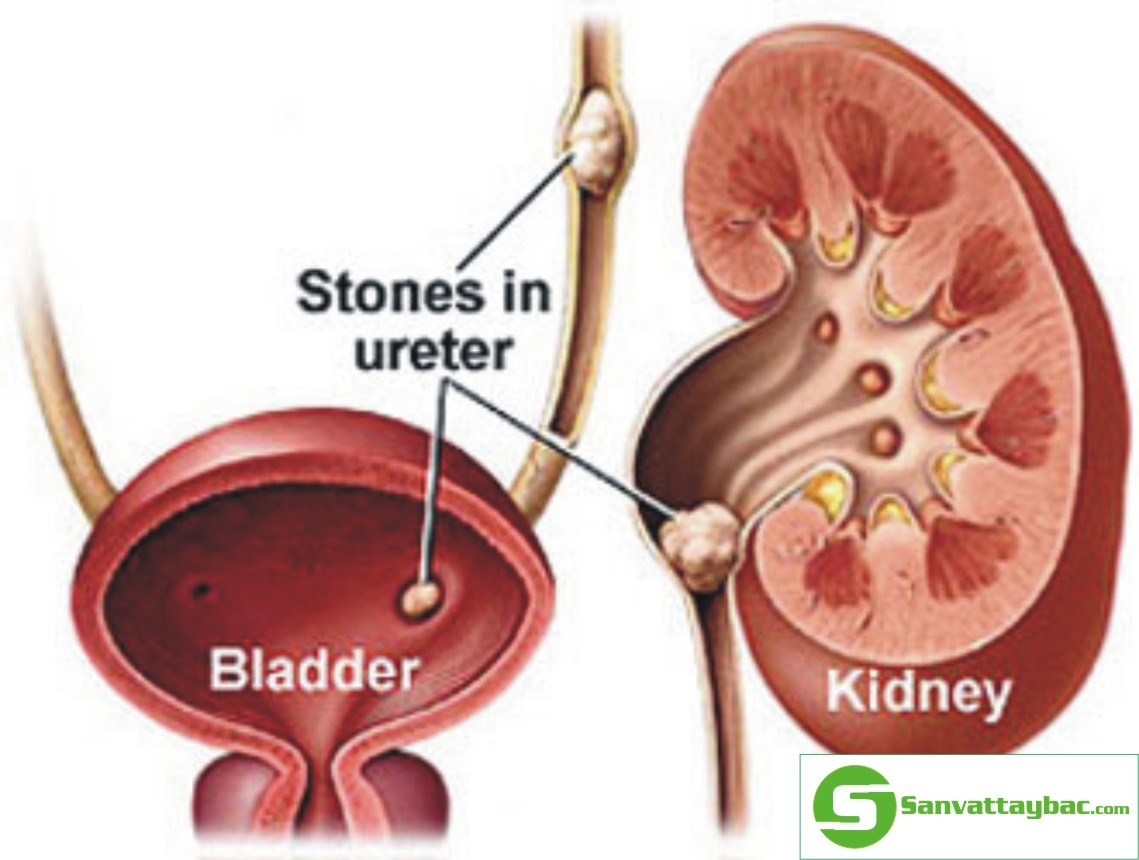 Bệnh viện chữa sỏi thận tốt bệnh viện Thu Cúc