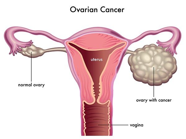 Bệnh viện khám tầm soát ung thư buồng trứng