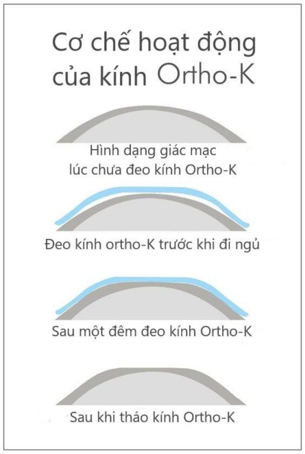 Bệnh viễn thị hình thành do đâu?