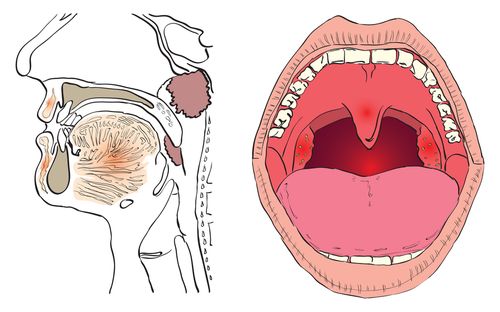 Bệnh viện Thu Cúc có điều trị viêm VA không?