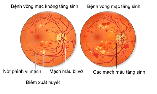 Bệnh võng mạc không tăng sinh và 4 điều cần biết