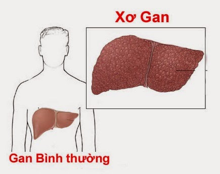 Bệnh xơ gan có chữa được không?