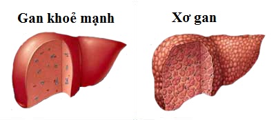 Bệnh xơ gan có lây không? thắc mắc của rất nhiều người