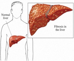 Bệnh xơ gan là gì? những điều cần quan tâm những vấn đề