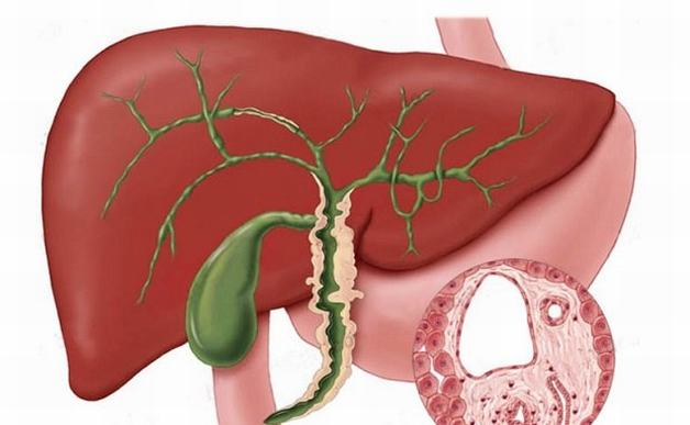 Bệnh xơ gan mật tiên phát và những biến chứng nguy hiểm