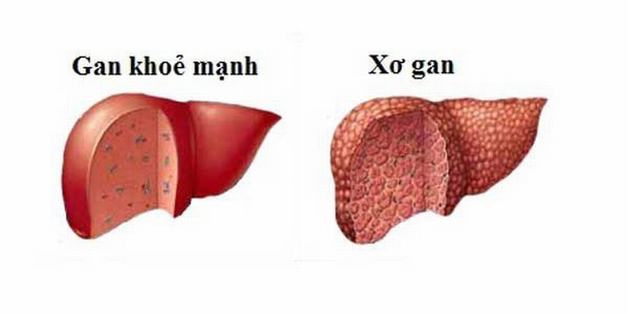 Bệnh xơ gan mật tiên phát và những biến chứng nguy hiểm