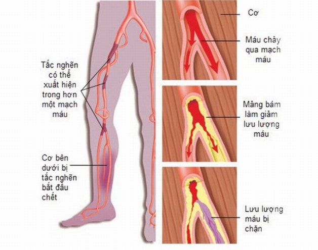 Bệnh xơ vữa động mạch chi dưới: Nguyên nhân và triệu chứng