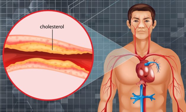 Bệnh xơ vữa động mạch vành biến chứng nguy hiểm không?