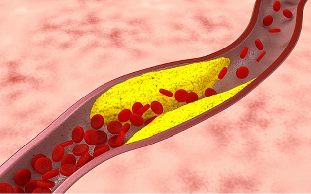 Bệnh xơ vữa mạch vành là gì? Cách chẩn đoán và điều trị