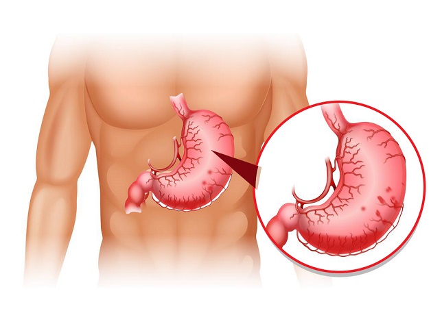 Bệnh xuất huyết tiêu hóa trên: Nguyên nhân và cách điều trị