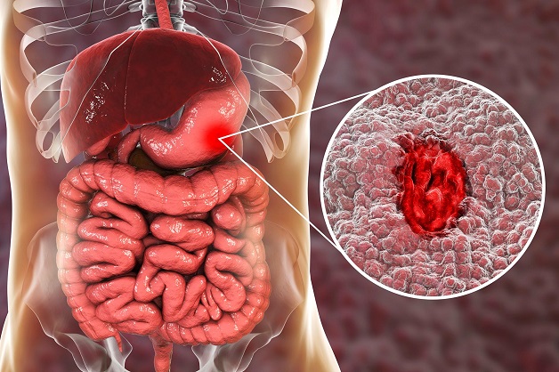 Bệnh xuất huyết tiêu hóa trên: Nguyên nhân và cách điều trị