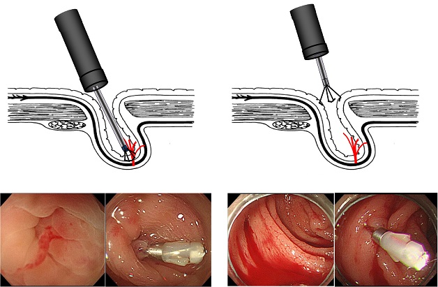 Bệnh xuất huyết tiêu hóa trên: Nguyên nhân và cách điều trị