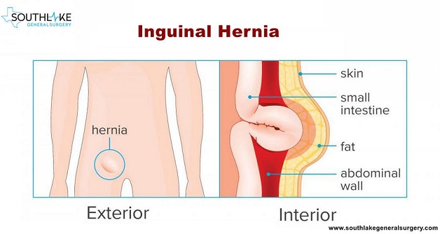 Bị bệnh thoát vị có nguy hiểm đến tính mạng không?