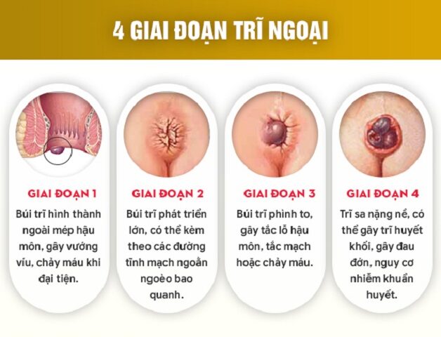 Bị bệnh trĩ chữa trị như thế nào?