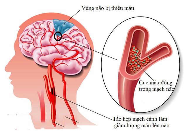 Bị đau đầu nên khám khoa nào để phát hiện chính xác?