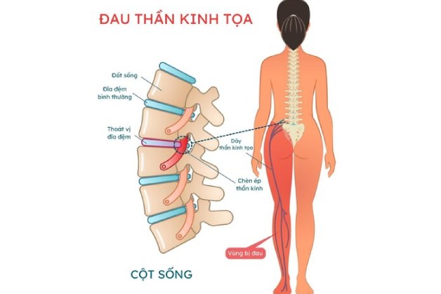 Bị đau dây thần kinh tọa nặng hơn vì 4 thói quen này