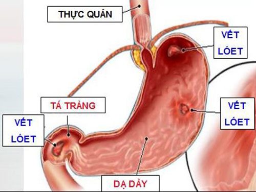 Bị đầy hơi lâu ngày nguyên nhân và cách chữa