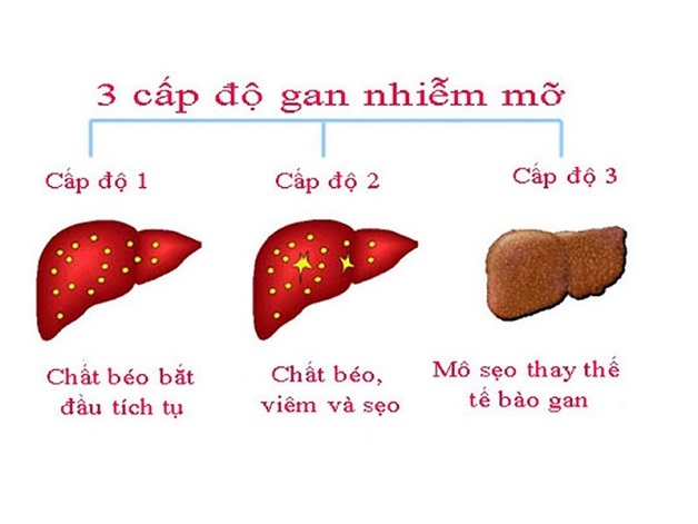 Bị gan nhiễm mỡ có nguy hiểm không, cách điều trị