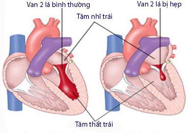 Bị hẹp van tim hai lá: Nguyên nhân và cách điều trị