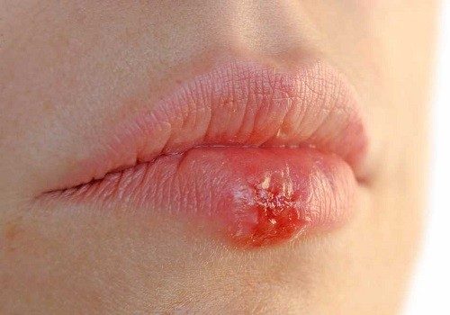 Bị herpes ở môi khi mang thai