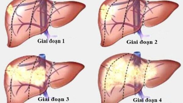 Bí kíp để ung thư gan vẫn sống khỏe mạnh