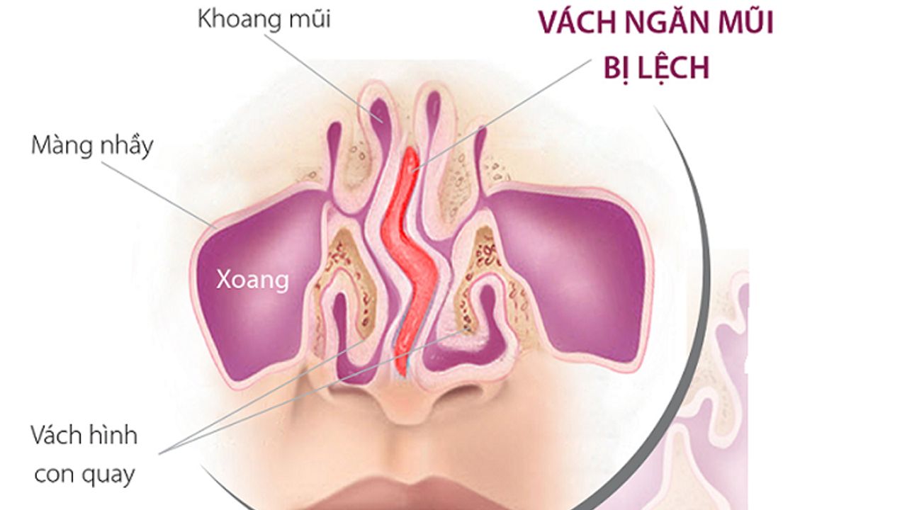 Bị lệch vách ngăn mũi có cần phải phẫu thuật không?