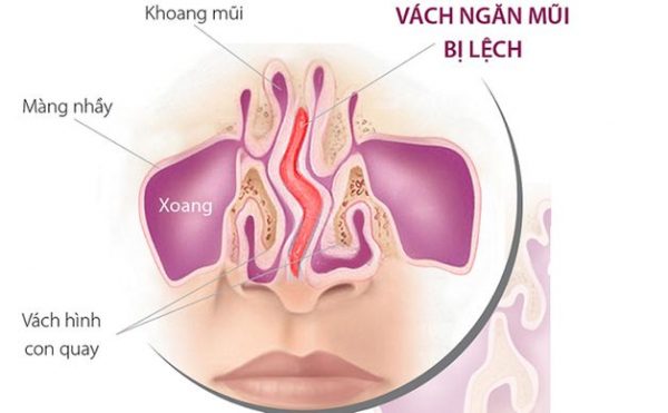 Bị lệch vách ngăn mũi có cần phải phẫu thuật không?