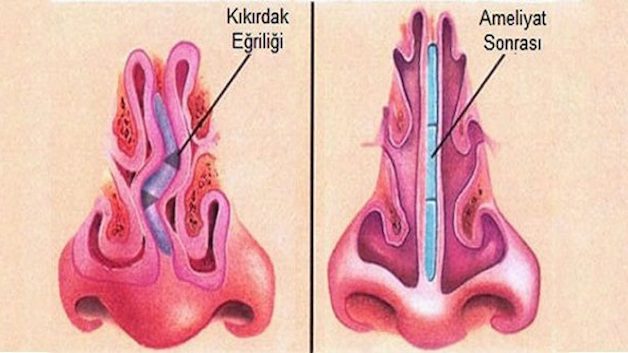 Bị lệch vách ngăn mũi: Nguyên nhân và dấu hiệu nhận biết